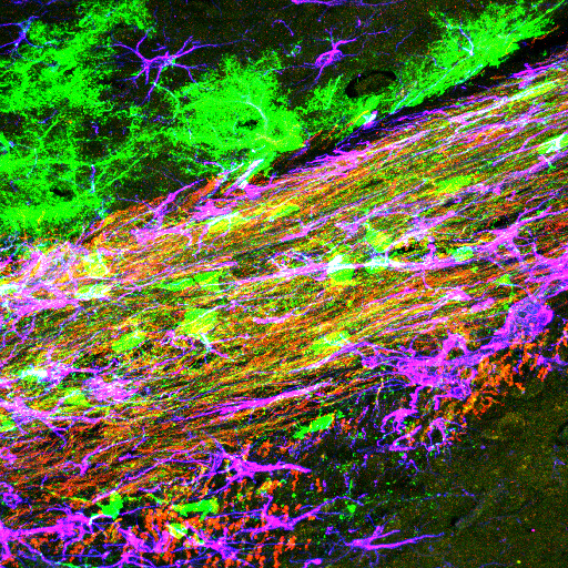Dr Fehlings and Lab Members Discuss the Clinical Use of Stem Cells for Cerebral Palsy on a DMCN podcast