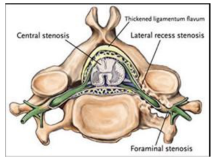 Stenosis Image
