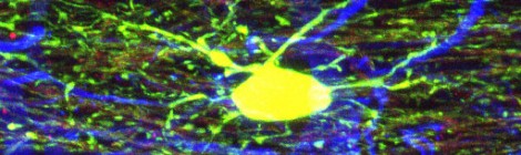 New Articles on the Potential of Stem Cells for Cerebral Palsy
