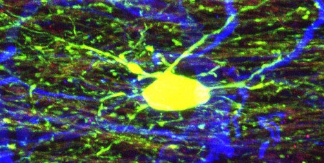 New Articles on the Potential of Stem Cells for Cerebral Palsy